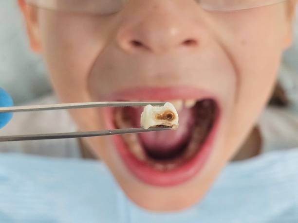 Best Broken or Chipped Tooth Repair in Willow Oak, FL